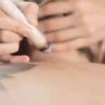 Met een moxa-stick het litteken na een keizersnede behandelen